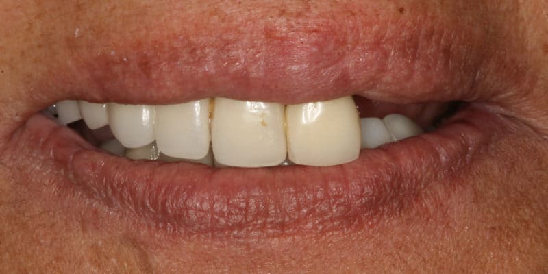 Shoshanna before - Lompoc Family Dental