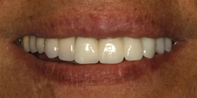 Shoshanna after - Lompoc Family Dental