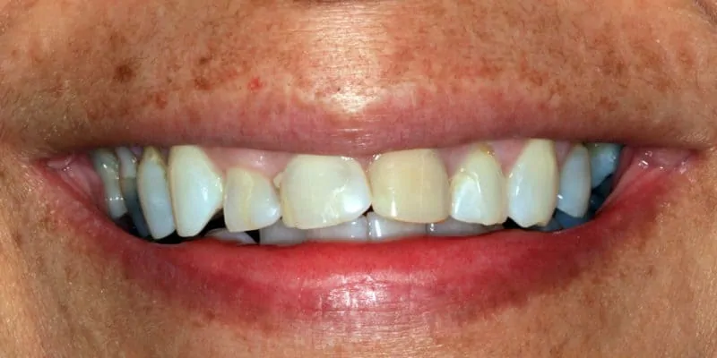 Gloria Before - Lompoc Family Dental
