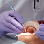 Dental hygienist performing cleaning before bridge placement