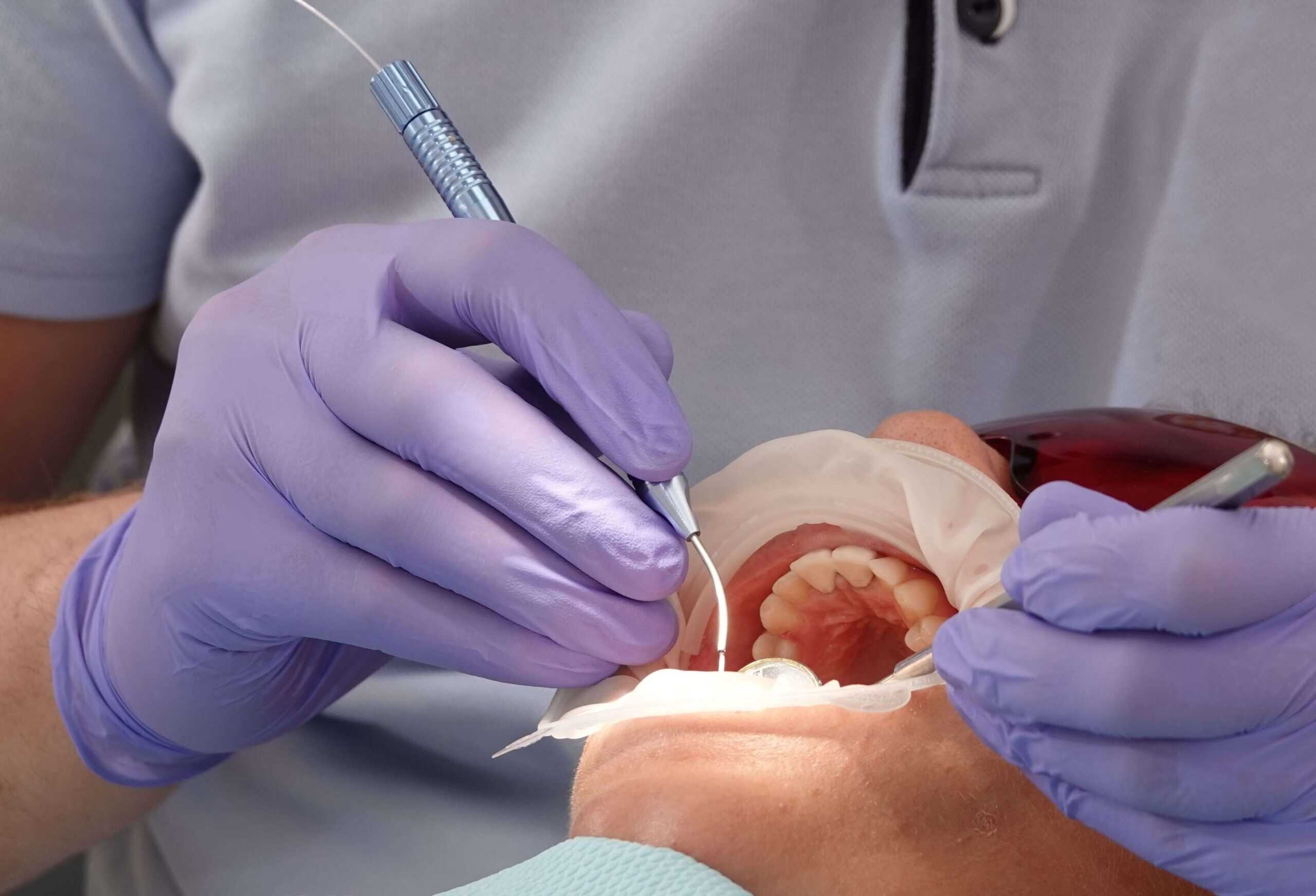 Dental hygienist performing cleaning before bridge placement