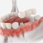 Bridge dental with 3 teeth fixed on molar and premolar.