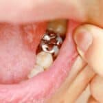Lower molar with silver amalgam dental restoration