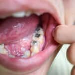 Tooth with multiple silver amalgam fillings in lower molars
