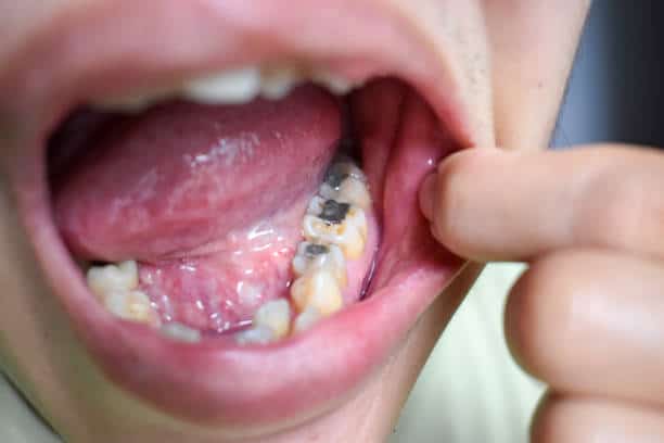 Tooth with multiple silver amalgam fillings in lower molars