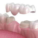 Problems with Dental Bridges