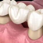 Candidate for Dental Bridges in Lompoc