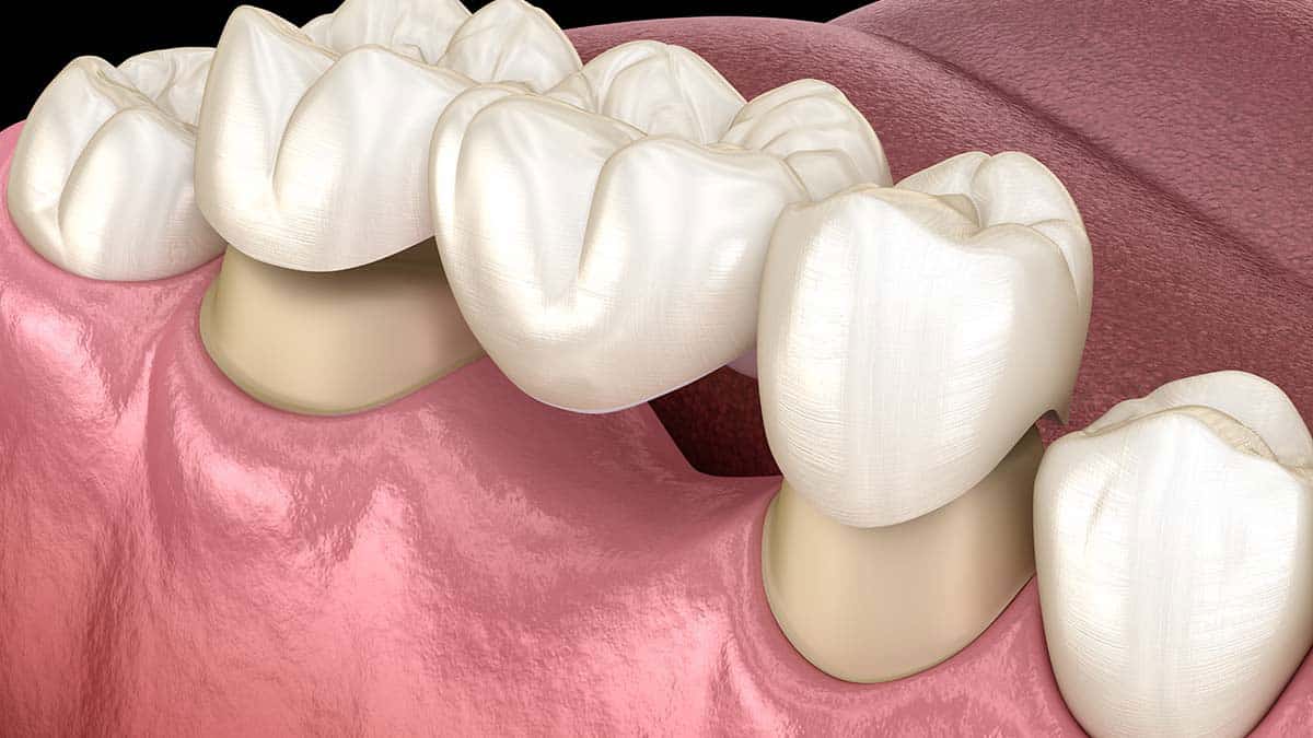 Candidate for Dental Bridges in Lompoc