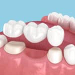How Long Does It Take to Get a Dental Bridge in Lompoc