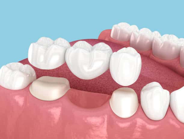 How Long Does It Take to Get a Dental Bridge in Lompoc