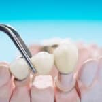 How to Care for a Dental Bridge in Lompoc