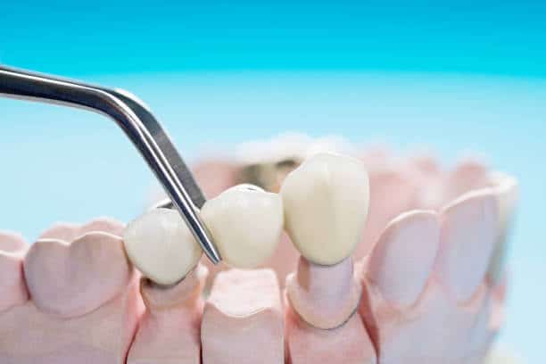 How to Care for a Dental Bridge in Lompoc