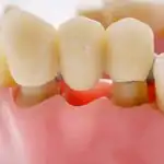 Replace dental bridge in Lompoc