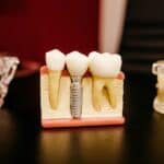 dental implants bone loss Lompoc