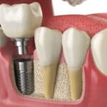 dental implant recovery timeline