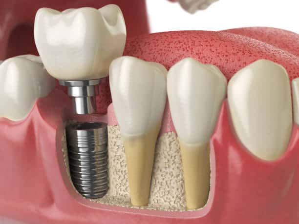 dental implant recovery timeline
