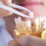 Understanding Dental Implant Costs in Lompoc