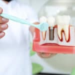 Dental Implants vs. Dentures in Lompoc