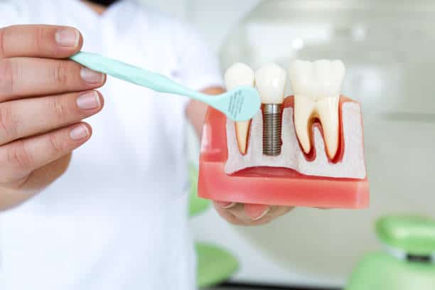 Dental Implants vs. Dentures in Lompoc
