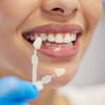 Dental Veneer