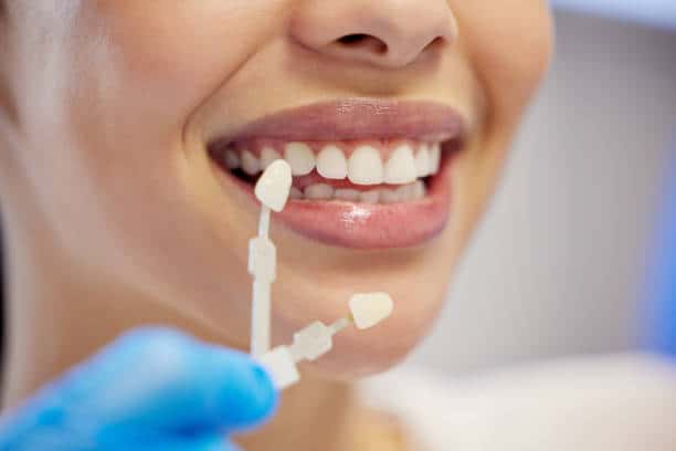 Dental Veneer