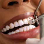Close up view of a dentist polishing a patient's teeth