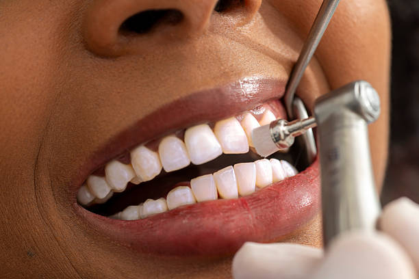 Close up view of a dentist polishing a patient's teeth