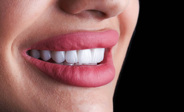 red lips and ceramic veneer teeth