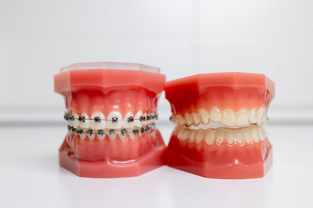 Dental models showing traditional braces next to clear aligners